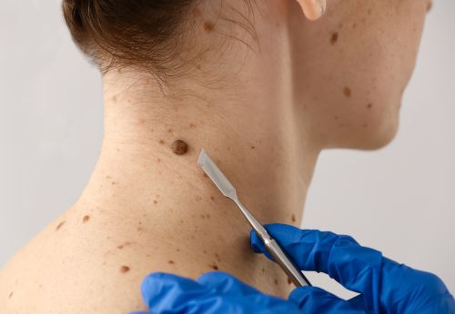 Skin Cancer Screening and Prevention Services: A Complete Guide for Early Protection and Healthy Skin