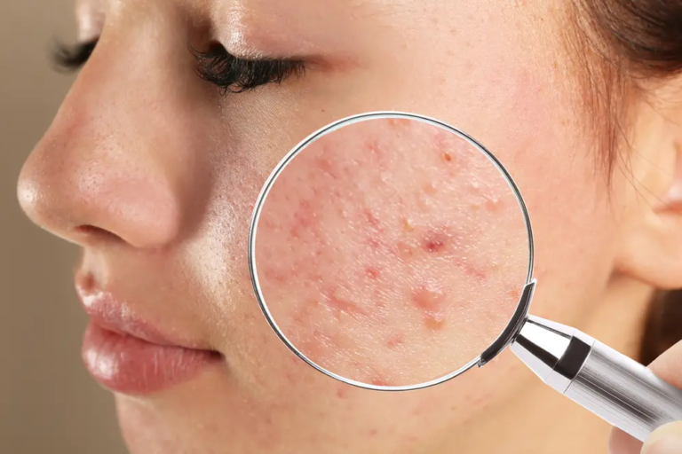 Dermatologist for Acne and Skin Treatment: A Complete Guide to Healthy, Clear Skin