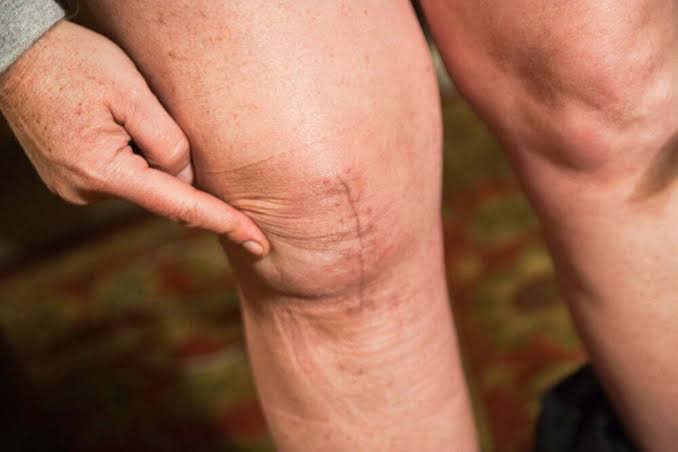 What To Know About Knee Replacement Recovery